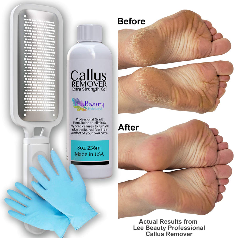 8oz Callus Remover Gel and Foot File/Foot Rasp Spa Kit. Professional Foot Care for dry, cracked heels. Soak in foot spa then apply callus gel to feet, and use foot scraper to peel off dead skin. - BeesActive Australia
