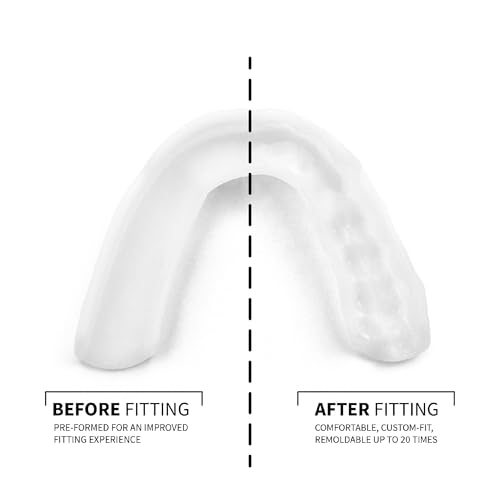 SOVA 3D Night Guard with Case - Pre-Formed, Easy-to-Fit Protection for Teeth Grinding, Clenching - Jaw Pain, Bruxism, TMJ Relief - Taste Free - Remoldable Up to 20 Times - Non Toxic