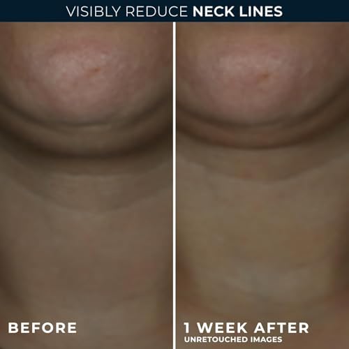 RoC Derm Correxion Neck Cream, Retinol + Hyaluronic Acid, Firming, 1.7 oz