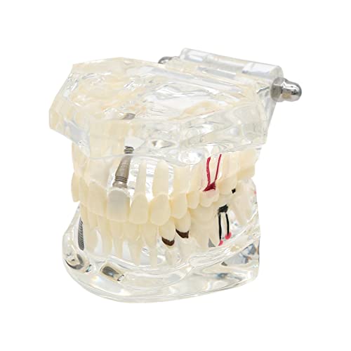 Dental Oral Typodont Model Implant Pathological Removable Teach Demo Visible Anatomy Demonstration Teaching Standard Size (Clear)