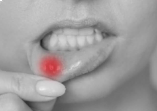Mouth Ulcer & Canker Sore Solution 4 Applicators