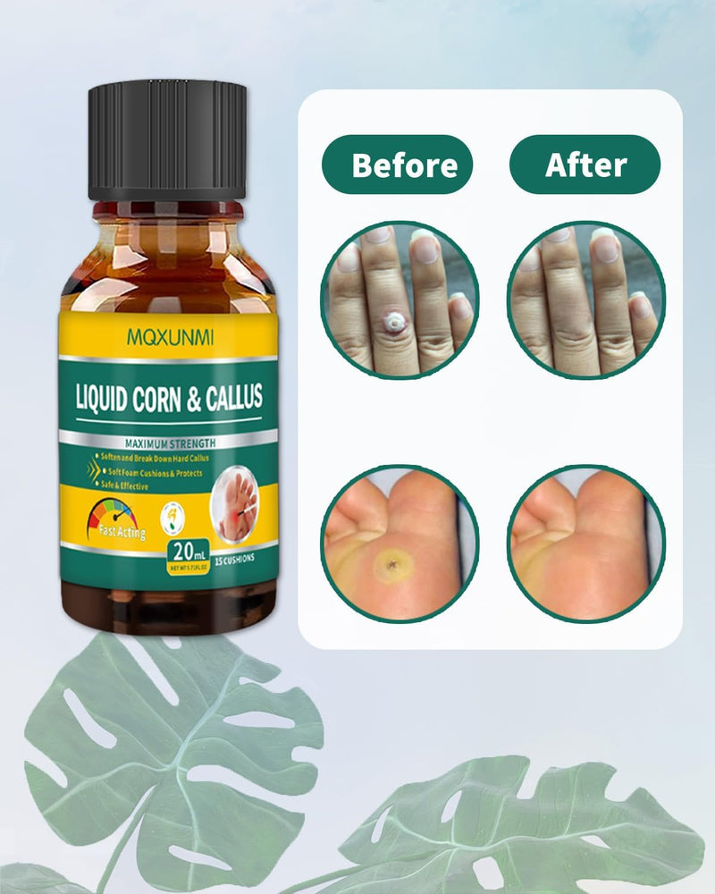 Corn Removers for Toes: Liquid Salicylic Acid Corn Removal for Feet - Corn Callus Remover for Feet Extra Strength (1ml)