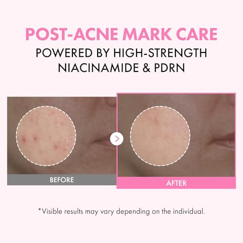 TOSOWOONG Pink PDRN Niacinamide Milky Toner for Dark Spots & Glow, Freckles