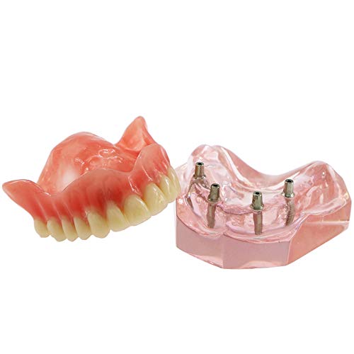 Dental Implant Teeth Demo Model Maxillary Overdenture with 4 Implants