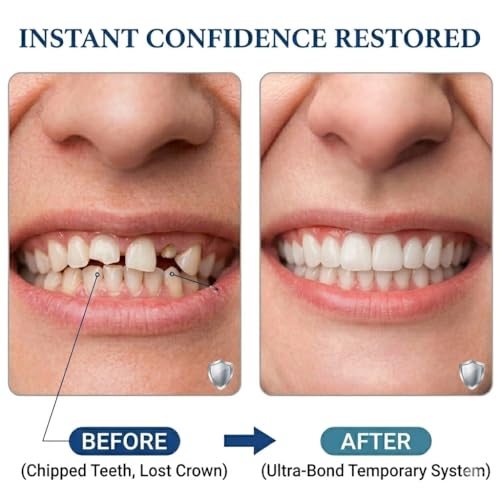 Tooth Repair Kit Zinc Oxide Eugenol Cement Dental Care Kit, Temporary Teeth Replacement, Dental Care Repair for Broken Chipped Teeth, Crown Fillings & Bridges 2PCS