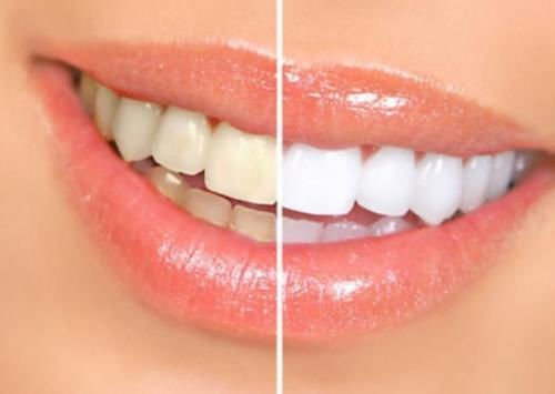 Bright White Smiles - 35% Teeth Whitening Kit - Tooth Gel Whitener and Trays Included - Made in The USA - Ships from Oral Care Dental Laboratory