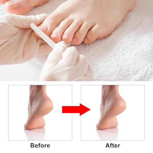7 Pcs Professional Pedicure Tools for Feet, Stainless Steel Ingrown Toenail Removal Blade Kit with File, Toe Nail Knife Set for Men Women,Corn and Rasp Callus Remover Foot Scraper for Dead Skin