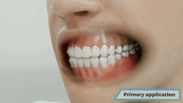 Ortho Chewz, Aligner Chew with Icy Mint Flavor, Orthodontic Chomper for Seating Aligners, Retainers and Oral Relief, Chew and Soothe, Dissolves in Mouth