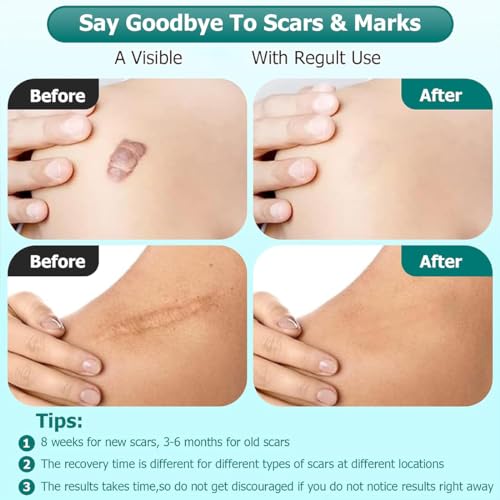 Advanced Scar Gel for Surgical Scars, Face, Body, Legs, Burns, Acne, C-Section, Stretch Marks, Keloids - Effective Scar Removal for Men and Women, Suitable for Old & New Scars (100% New -1 Bottle) 100% New -1 Bottle