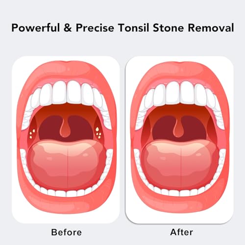 Electric Tonsil Stone Remover – High-Precision & Painless Cleaning, Food-Grade Material, 6 Suction Levels | Tonsil Stone Removal Kit with LED Light, Oral Protection & 11 Attachments