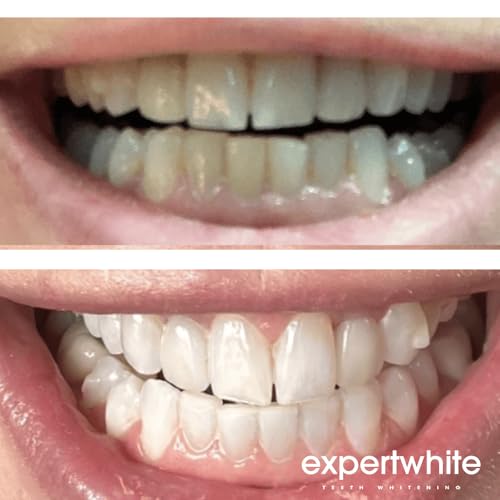 16% Carbamide Peroxide Teeth Whitening Gel – Sensitive Teeth Formula – Made in USA – Professional Refill Syringes (4 x 3cc) for Use with Whitening Trays