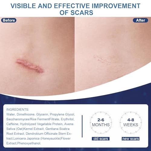 Scar Cream,Silicone Scar Gel,Helps Reduce Surgical Scars,Acne,Burn,Keloids Bump,Stretch Marks, Advanced Scar Removal Cream for Old and New Scars(1.69oz) 1.69 Ounce