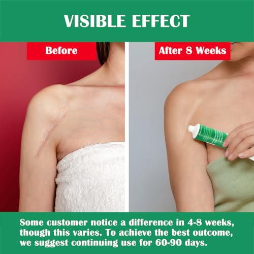 Advance Silicone Scar Cream Gel: Old & New Scars Treatment Stretch Marks Removal - Body Face Surgical Skin Healing - Recovery C-Section Keloids Injury Acne Wound Dark Spot for Kids 1oz (30 g) (Green)