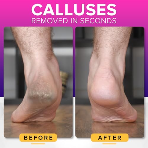 NYK1 RUSTPROOF Foot File Callus Remover for Feet with Catcher | XL Size