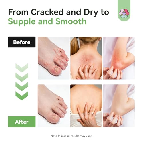 SAVILAND Antifungal Cream Athlete's Foot Jock Itch Ringworm Treatment 4.2oz