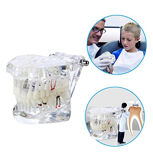 Dental Oral Typodont Model Implant Pathological Removable Teach Demo Visible Anatomy Demonstration Teaching Standard Size (Clear)