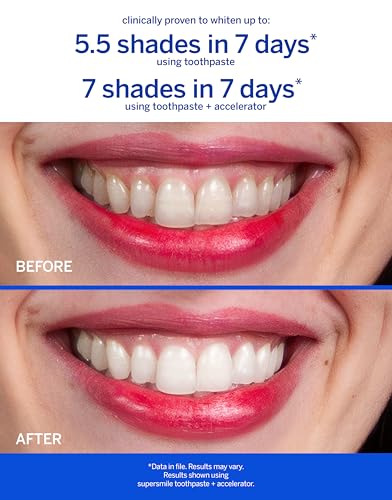 Supersmile Fluoride-Free Whitening Kit, Citrus Blast, 1.4 Oz Travel
