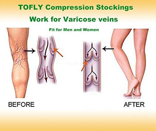 TOFLY® 30-40mmHg Medical Graduated Compression Socks for Men & Women, Open Toe Knee High Compression Socks,Firm Support for Circulation Recovery,Shin Splints,Varicose Veins,Edema,Nursing Small 30-40mmhg Open-toe Beige - BeesActive Australia
