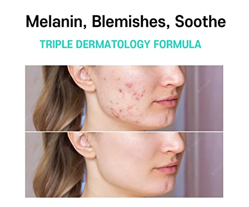 Melasma Treatment for Face Cream - Dark Spot Remover Cica 40ml/1.35 fl.oz