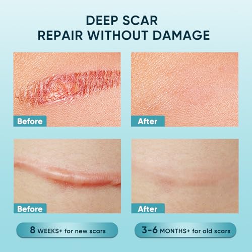 Scar Gel, Scar Cream, Advance Scar Gel for Surgical Scars for Surgical Scars, C-Section, Stretch Marks, Acne, Injury, Burns, Keloids, Old and New Scars,1.7oz