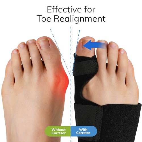 Fittest Pro Bunion Corrector (2pcs), Orthopedic Bunion Splint, Big Toe Separator Pain Relief, Non-Surgical Hallux Valgus Correction, Hammer Toe Straightener, Day Night Support