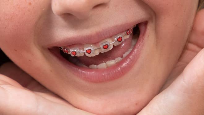 Braces Bumper Cover, Orthodontic Bracket Wax Substitute, Alternative Snap-on Braces Guard Braces Accessories 10 pack (Hearts) Hearts