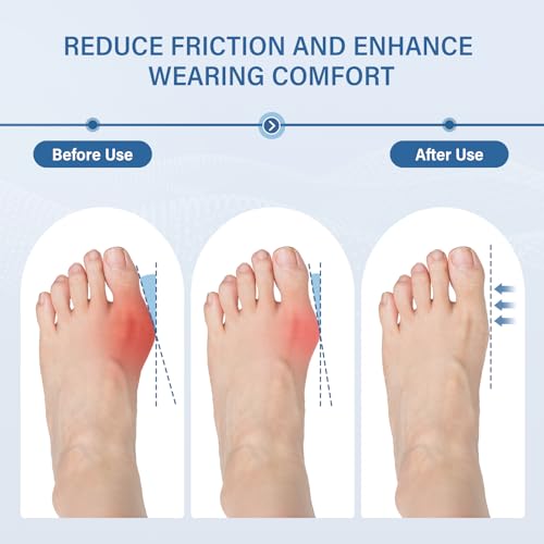 Bunion Corrector 2-Pack for Women & Men, Ultra-Thin Toe Splint Large
