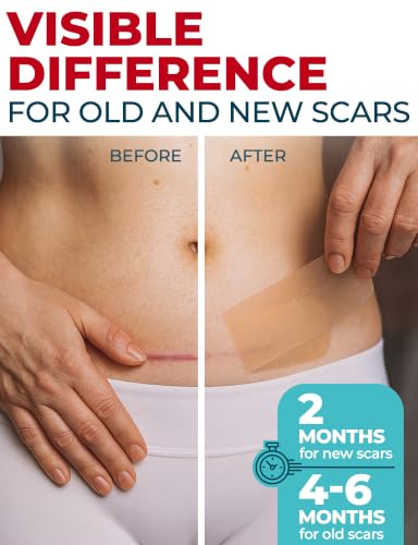 Medical Grade Silicone Scar Tape - 1.6"x70" - Effective Scar Removal 70"x1.6" Beige