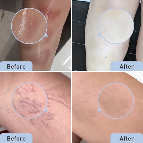 PROcure Arnica & MSM Bruise Remedy Gel for Bruises and Spider Veins