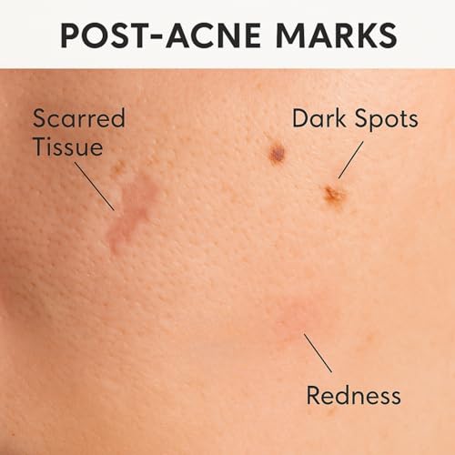 Acne Scar & Dark Spot Patches – Gentle Non-Adhesive Silicone Dots, Safe for Sensitive Skin – Ultra-Thin, Breathable & Nearly Invisible – 72 Pimple Patches, 2 Sizes