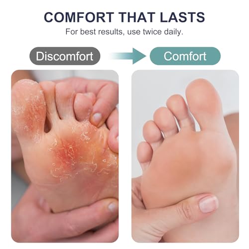 Antifungal Cream for Athlete’s Foot, Jock Itch - 1% Clotrimazole
