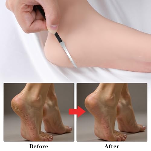 6 Pack Ingrown Toenail Removal Kit, Professional Pedicure Tools for Ingrown Toenail Callus Shaver Corn Removers for Toes Stainless Steel Nail Knives Kit with Storage Box