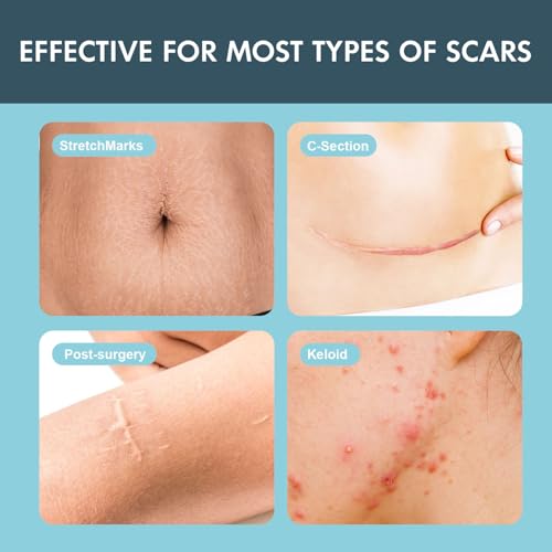 Silicone Scar Sheets, Silicone Scar Tape for Scar Removal Treatment (1.6”x 60” Roll-1.5M), Reusable Silicone Scar Strips for Surgical, C-Section, Tummy Tuck, Keloid Scars, Burn, Acne