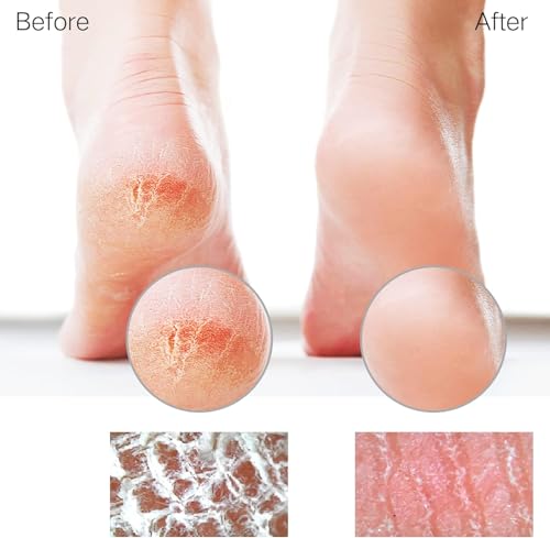 Glass Foot File Callus Remover for Feet, Heel Scraper, Pumice Stone, Diabetic Feet Scrubber Dead Skin Remover for Feet Professional Pedicure Tools Coarse-pro