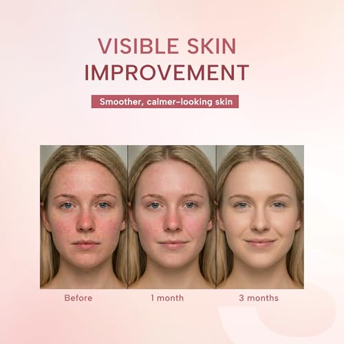 suquato 10% Azelaic Acid Cream – Rosacea Treatment for Face & Redness Reducing Face Cream – Redness & Blemish Care for Sensitive Skin – Lightweight Daily Use 30g 1 Fl Oz (Pack of 1)