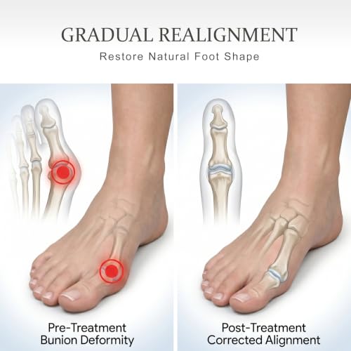 2Pcs Bunion Corrector with Adjustable Knob & 2Pcs Silicone Shoe Inserts for Day Use, Toe Separators for Men Women, Big Toe Straighteners for Hallux Valgus, Overlapping Toes, Hammer Toe Relief, Gray Gray 2 PCs