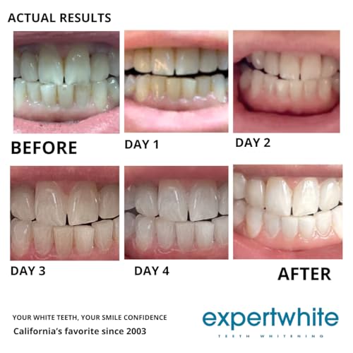 22% Carbamide Peroxide Teeth Whitening Gel – Professional-Strength Refill Syringes – Made in USA – 4 x 3cc – Use with Custom or Universal Trays