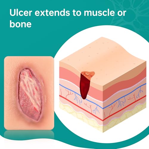 Pressure Ulcer Wound Model Stage 4 Pocket Size