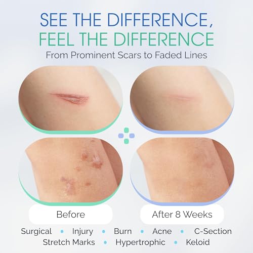 Brush On Medical Grade Silicone Scar Gel Wand for Facial Scars Post Procedure, Peel, Dermabrasion, Non-Comedogenic, Hypoallergenic. Soothe, Prevent, Repair and Restore Serum for Face