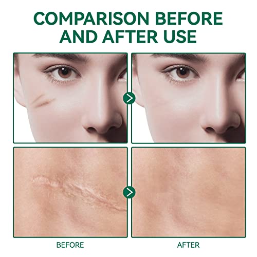 Scar Gel, Scar Removal Cream, Scar Treatment for Surgical Scars, Acne, Burn, C-Section, Keloid, Burn, Acne, Tummy Tuck, Remover Scar for Old or New, Kids, Men, Woman, 50Ml