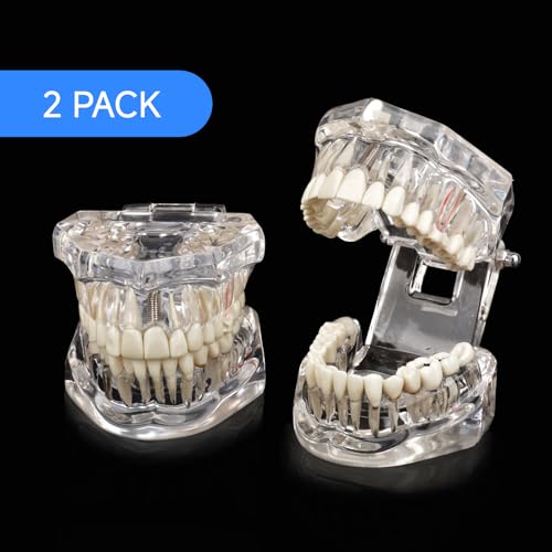 Ultrassist, Transparent Disease Teeth Model 2-Pack with Removable Teeth