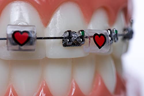 Braces Bumper Cover, Orthodontic Bracket Wax Substitute, Alternative Snap-on Braces Guard Braces Accessories 10 pack (Hearts) Hearts