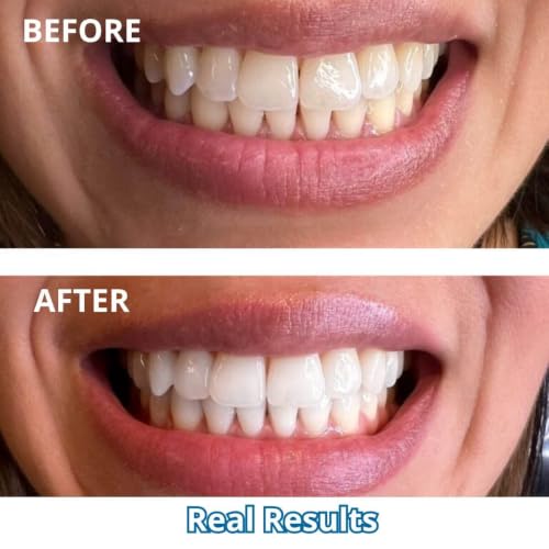Pro Teeth Whitening Kit 32X LED Light, 4 Carbamide Peroxide Gel Syringes & Whitening Tray Professional At-Home Teeth Whitener for Sensitive Teeth, Removes Coffee, Tea, Wine, Smoking Stains