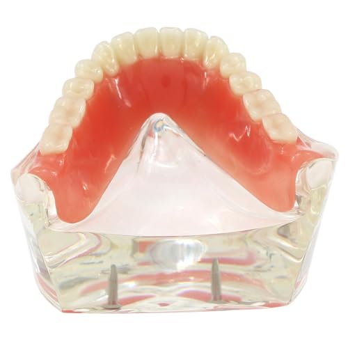 Dental Implant Restoration Model Mandibular Overdenture with 2 Implants