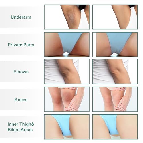 Skin Bleaching Cream Skin Lightening for Body Intimate Areas, Private Parts, Underarm, Knees, Elbows, Inner Thigh, Bikini Area, Whitening Cream Dark Spot Remover For Intimate Areas (1FL OZ) 1 Fl Oz