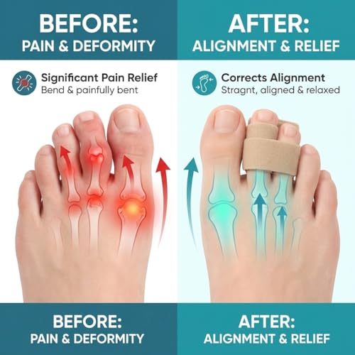 Hammer Toe Straightener & Toe Brace Wrap for Women and Men, Toe Splint for Straightening and Alignment, Hammer Toe Support, 6Pack (Beige) Beige
