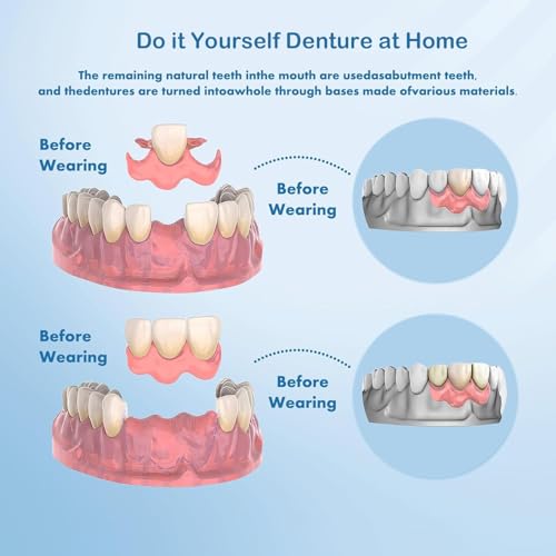 DIY Denture Complete Kit with Impression Material, Gum Material, Components for Top and Bottom Full or Partial Dentures, Do-It-Yourself Solution