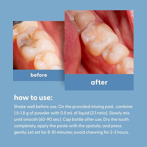 Dental Repair Kit for Lost Crowns, Fillings & Cavities w/Travel Case by M3