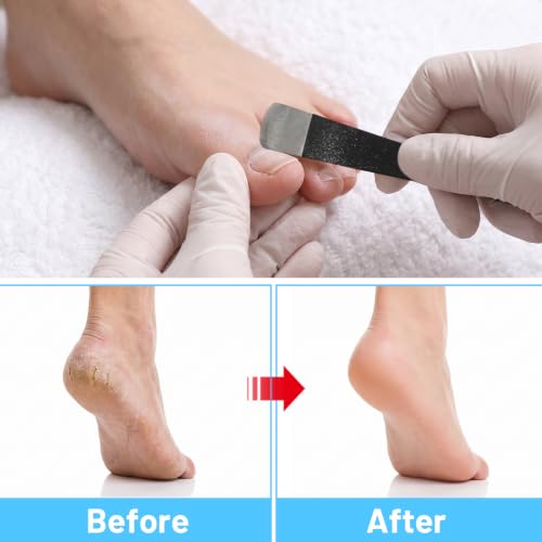 6Pcs Ingrown Toenail Removal Kit, Pedicure Tool Feet Corn Remover
