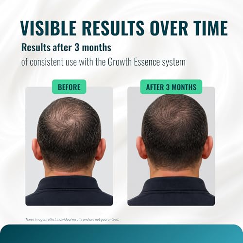 Minoxidil 5% Cream with Biotin, Caffeine & Hyaluronic Acid – Topical Cream Format for Hairline & Beard – Fragrance Free – 3.4 oz